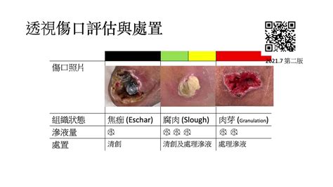 嘴巴縫針|縫針：依據傷口長度與深度評估是否需要